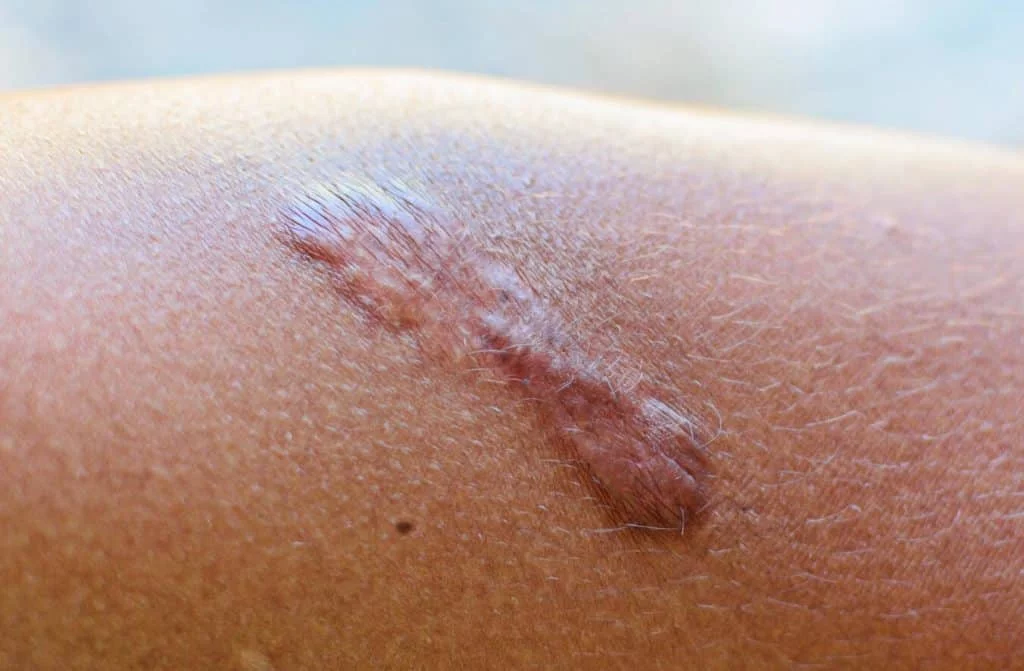 cicatrice chéloïde