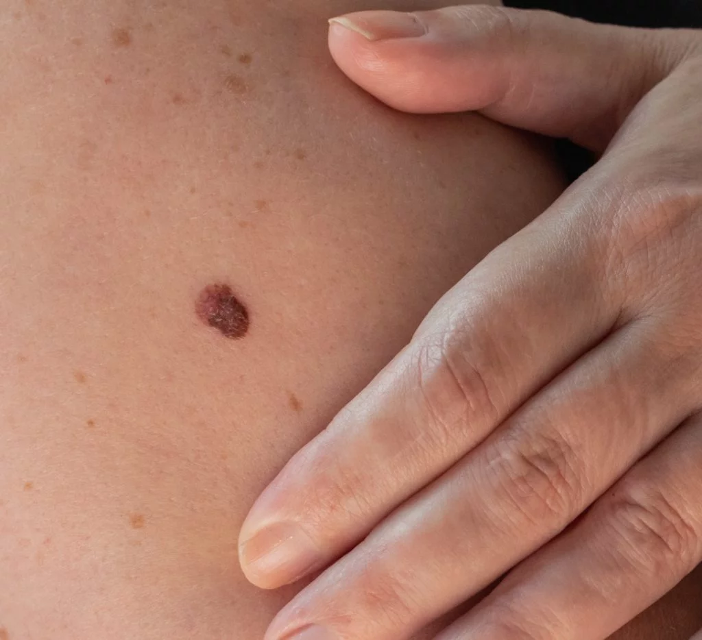 Cancer de la peau dépistage chirurgie dermatologique Paris