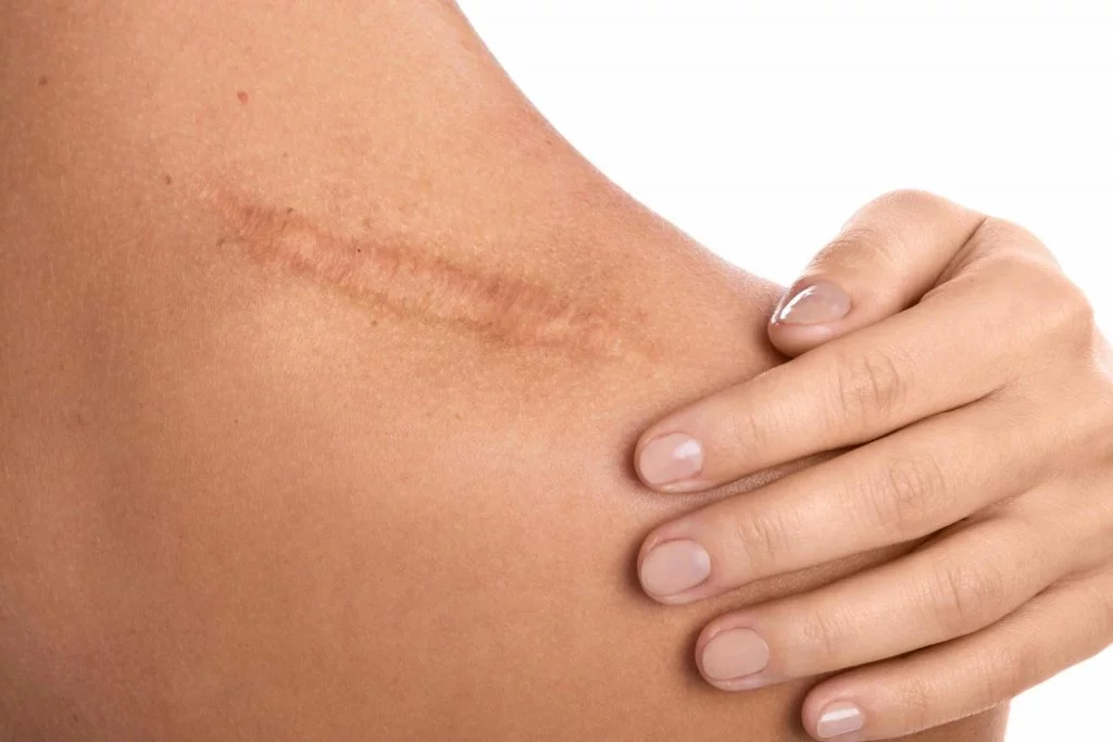 Cicatrice traitement chirurgie dermatologique Paris