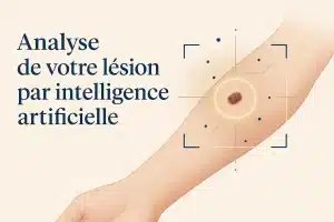 Analyse d’une lésion cutanée (grain de beauté) par intelligence artificielle — outil d’orientation SOS Chirurgie Dermato, Paris
