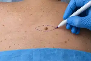 Tracé en fuseau dessiné autour d’un grain de beauté avant son ablation